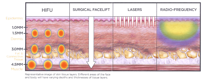 non-surgical facelift singapore