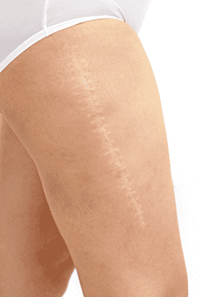 scar removal singapore