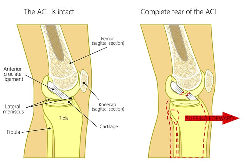 acl tear singapore