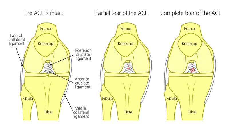 acl tear singapore