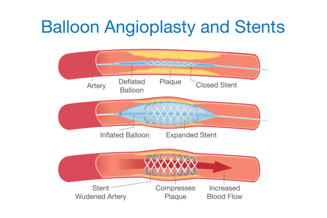 angioplasty singapore