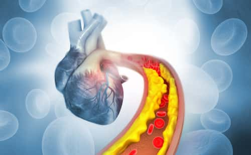 blocked heart vessels