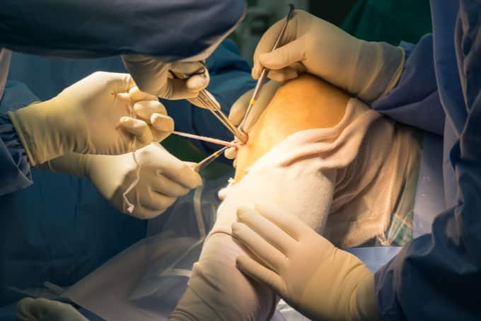 acl reconstruction singapore