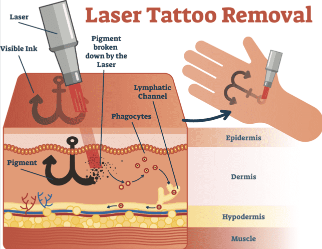 tattoo removal laser singapore