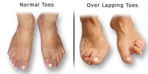 normal and overlapping toes