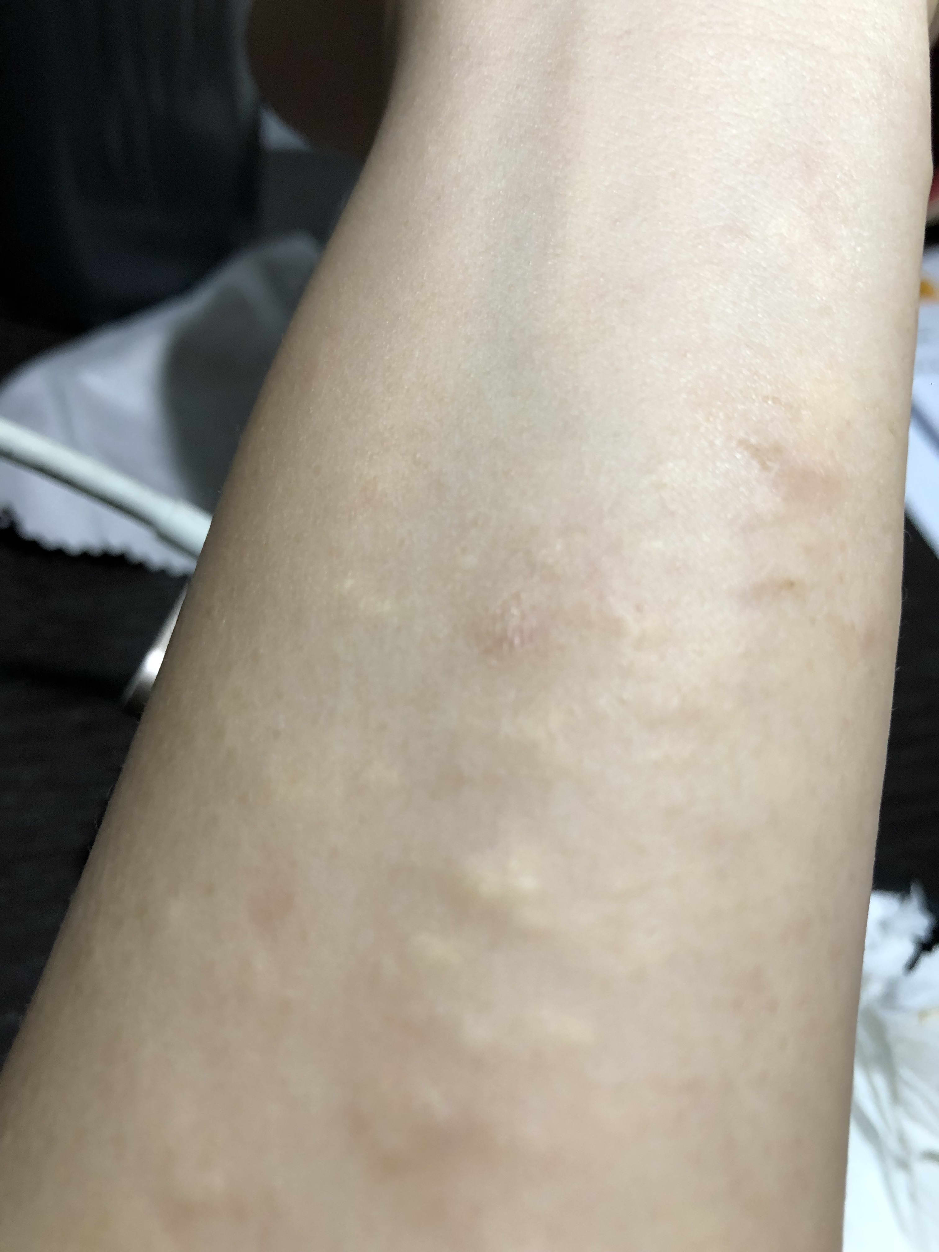 White Bumps On Forearm