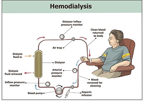 hemodialysis singapore