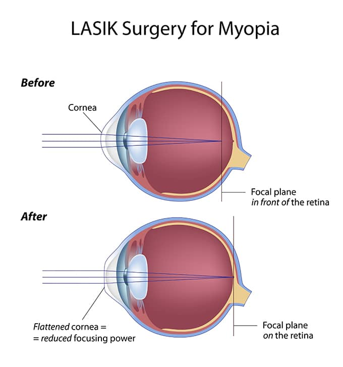 LASIK surgery singapore for myopia