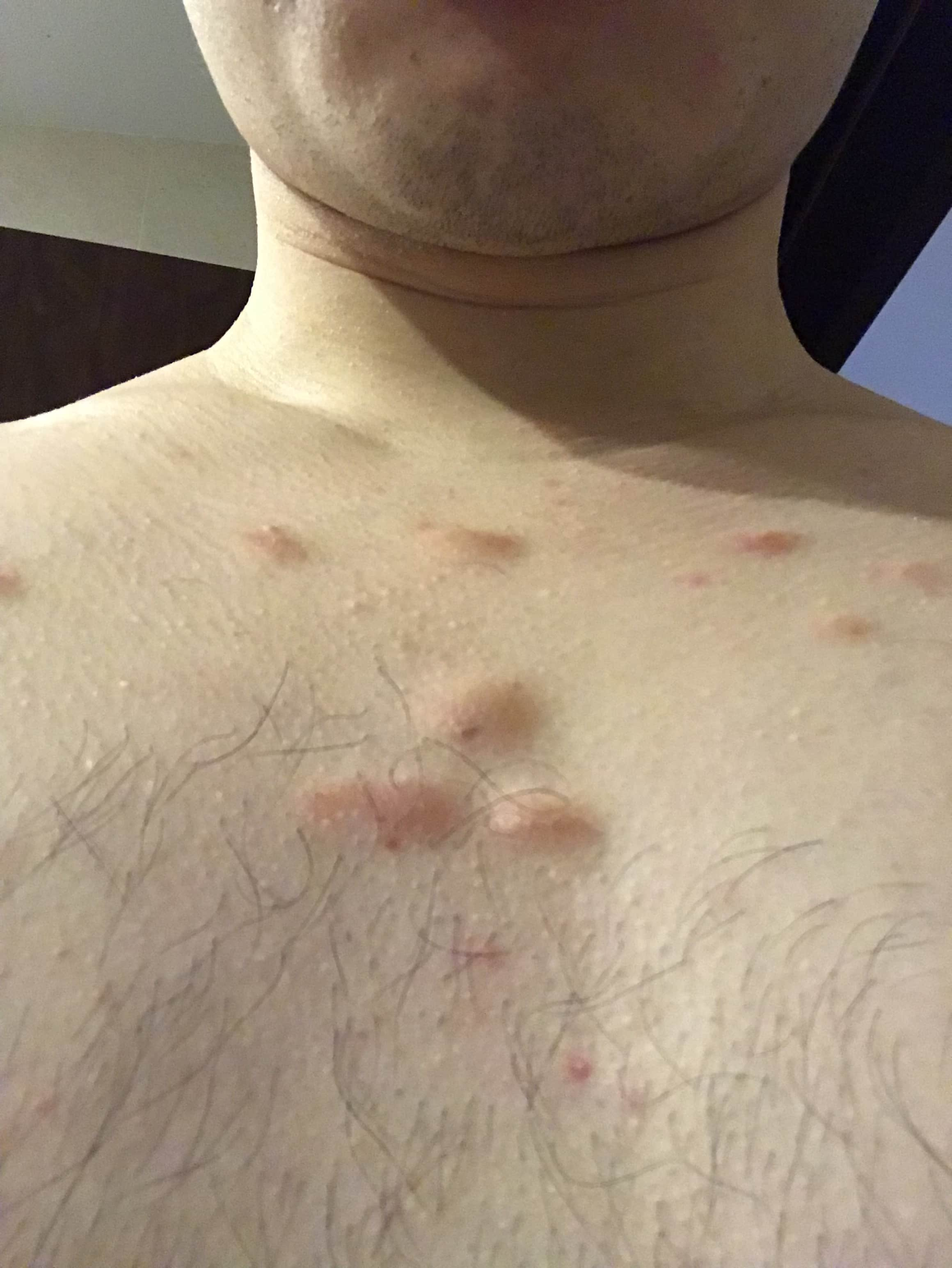 Little Red Bumps On My Chest And Stomach