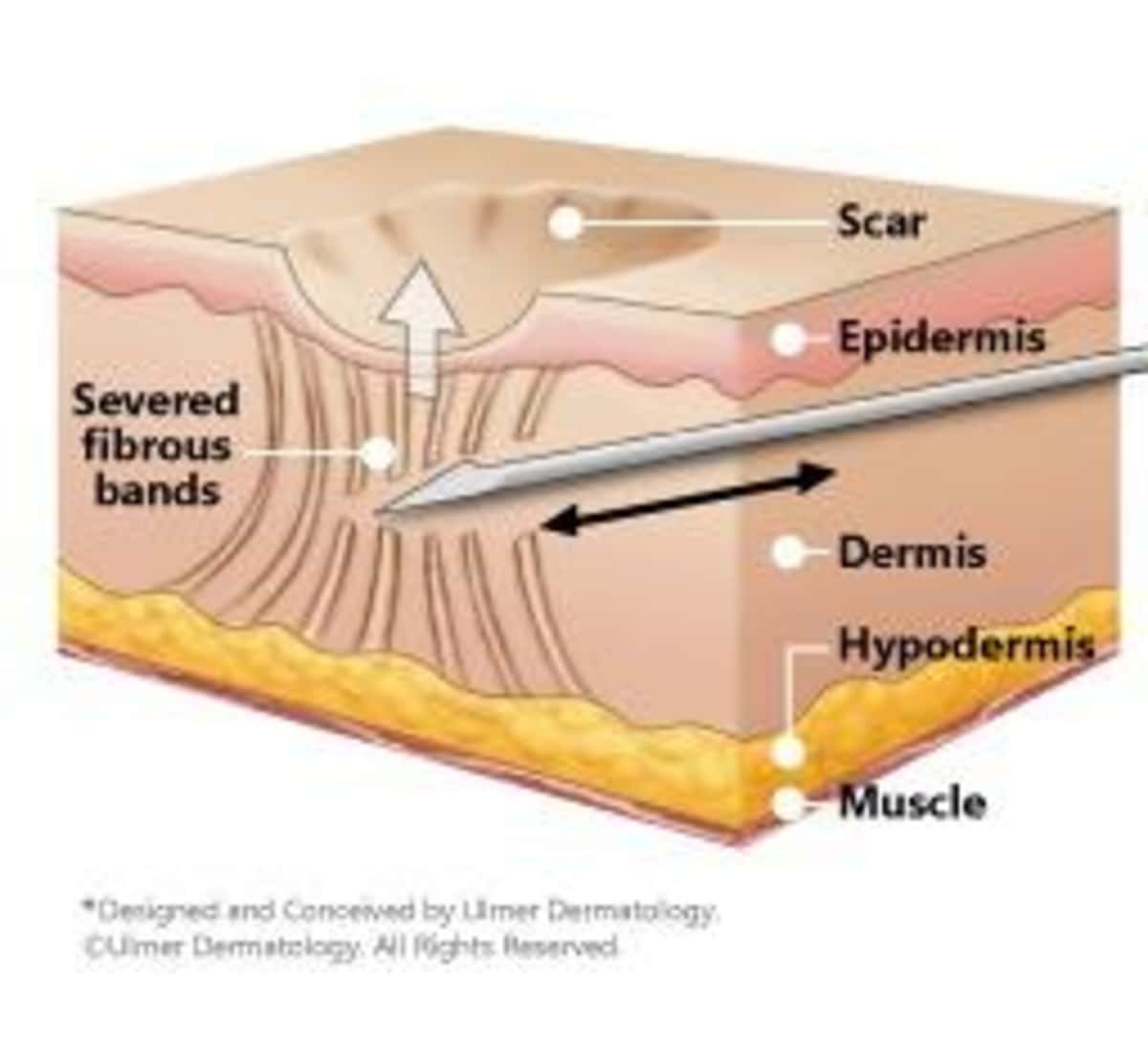 Subcision for deep acne scars