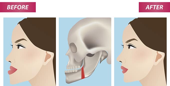 jaw surgery singapore