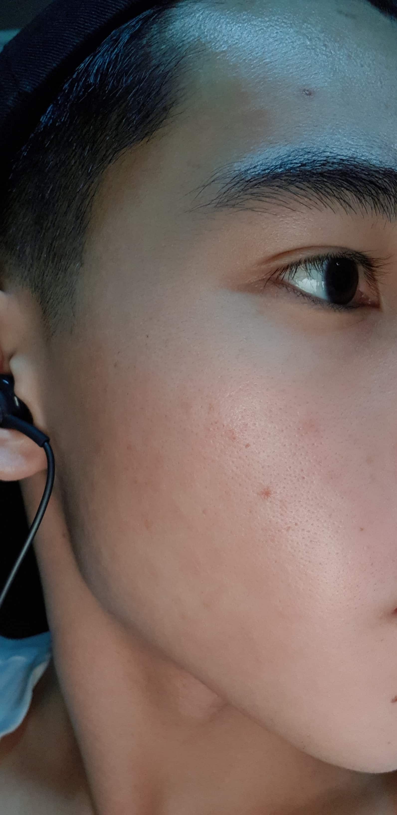 How to get rid of mild acne scars and marks? (photo) - human