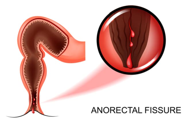 anal fissure singapore