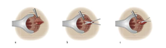 anal fissure surgery singapore