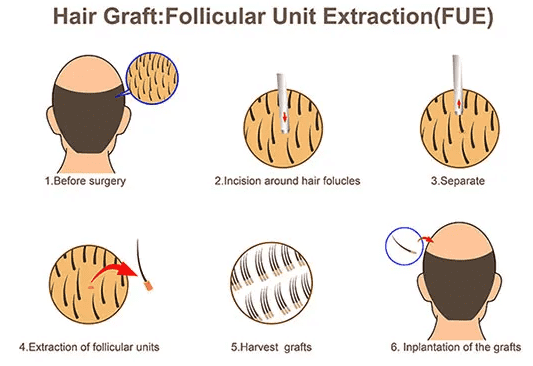 hair graft FUE singapore