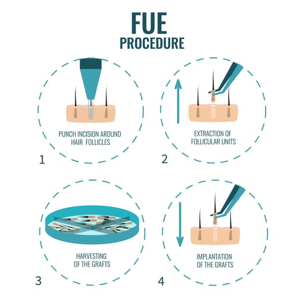 FUE hair transplant process singapore