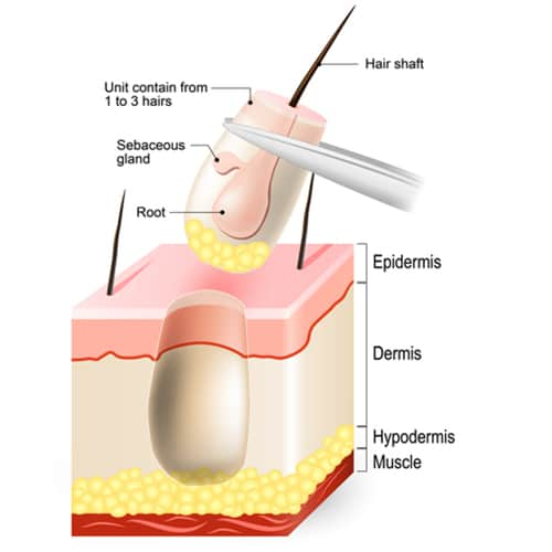 hair transplant singapore