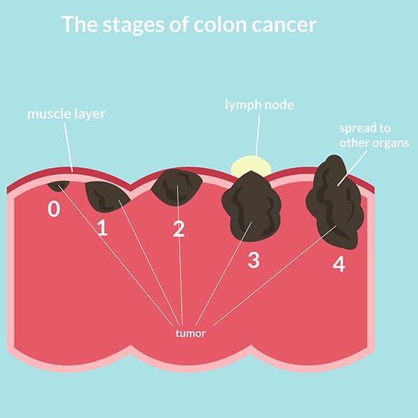 stages of colon cancer singapore