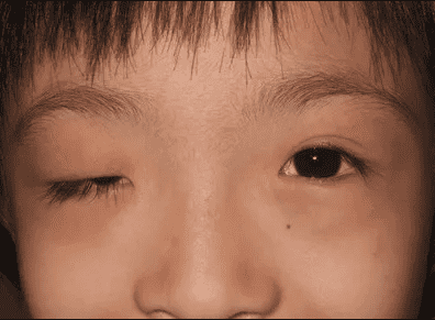 ptosis in children singapore