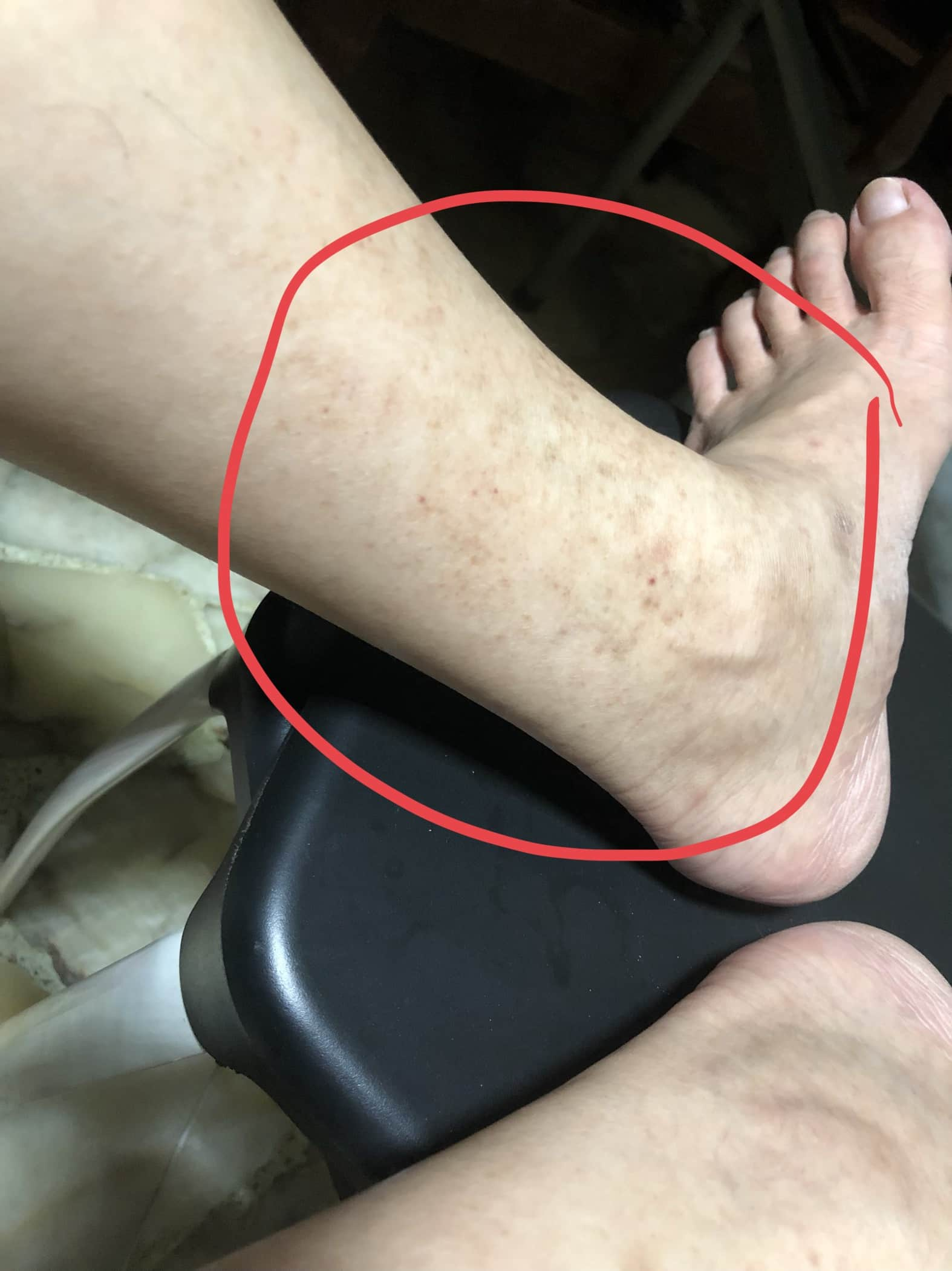 What Can Cause Brown Spots And Patches Appearing At My Ankle And Shin Photo Human 