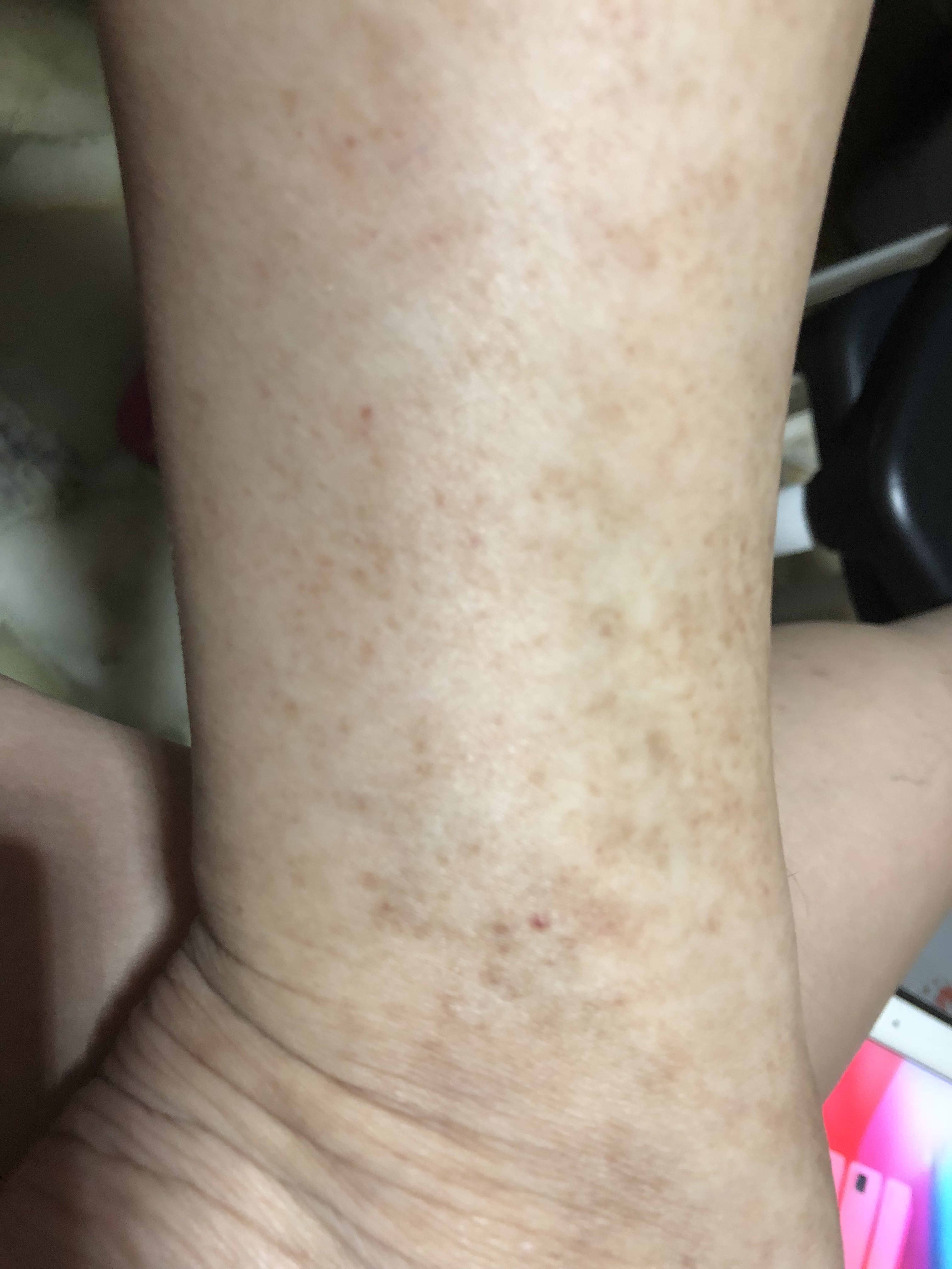 Light Brown Spots On Lower Legs 