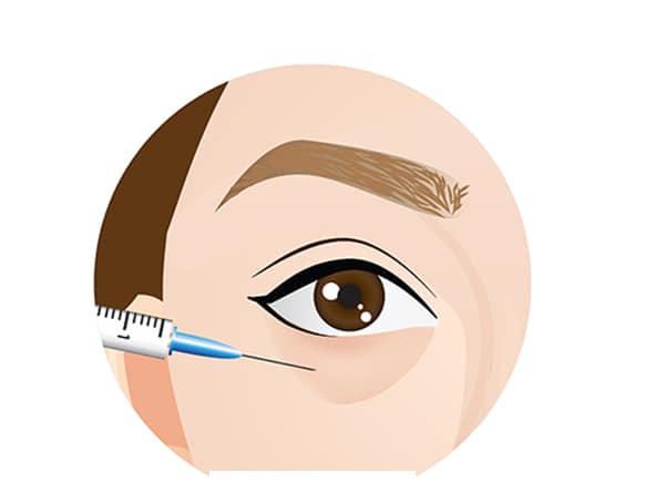 dermal filler for dark eye circles singapore