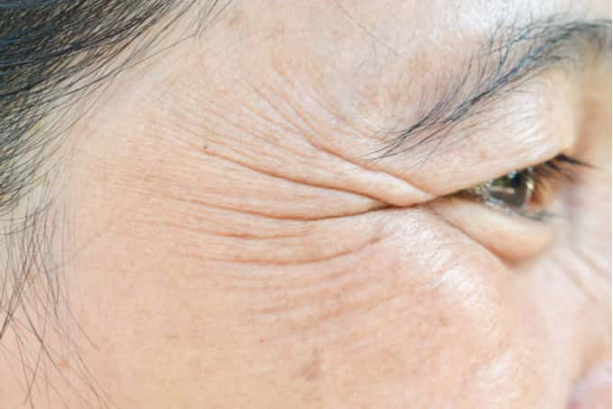 treatment for crows feet singapore