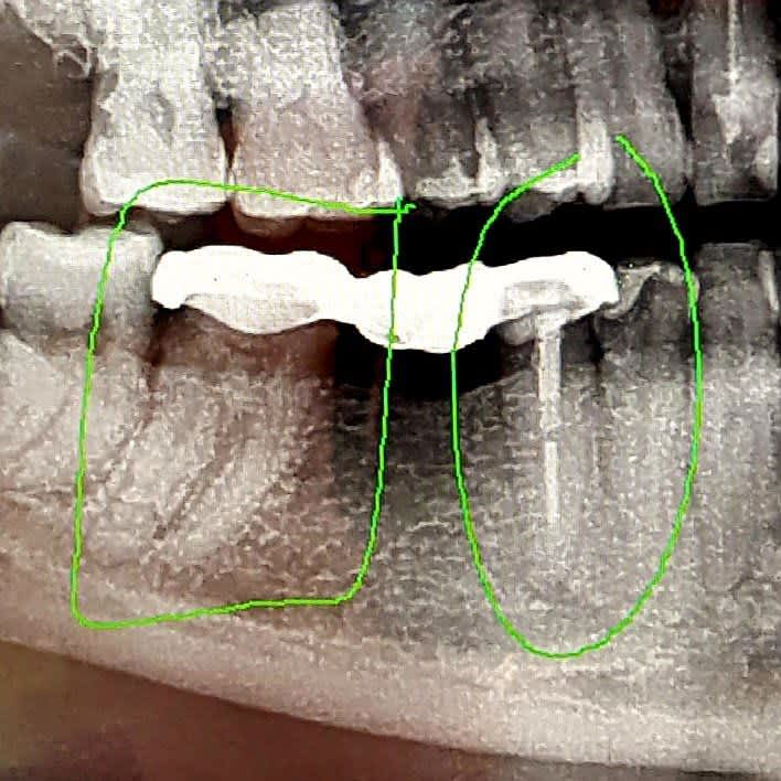 Shubhada Bhide dental implant singapore