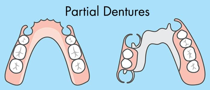 replace missing tooth partial dentures singapore