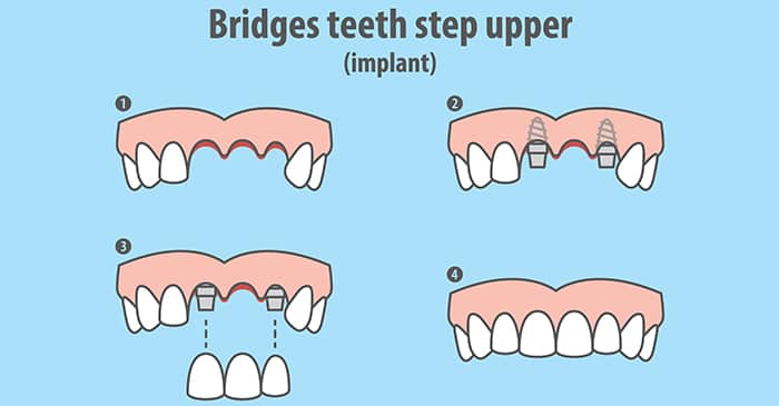 replace missing tooth bridges singapore