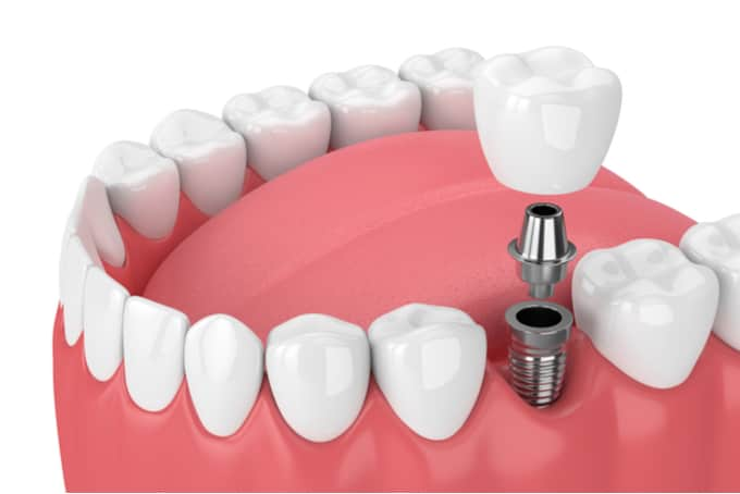 dental implant procedure singapore