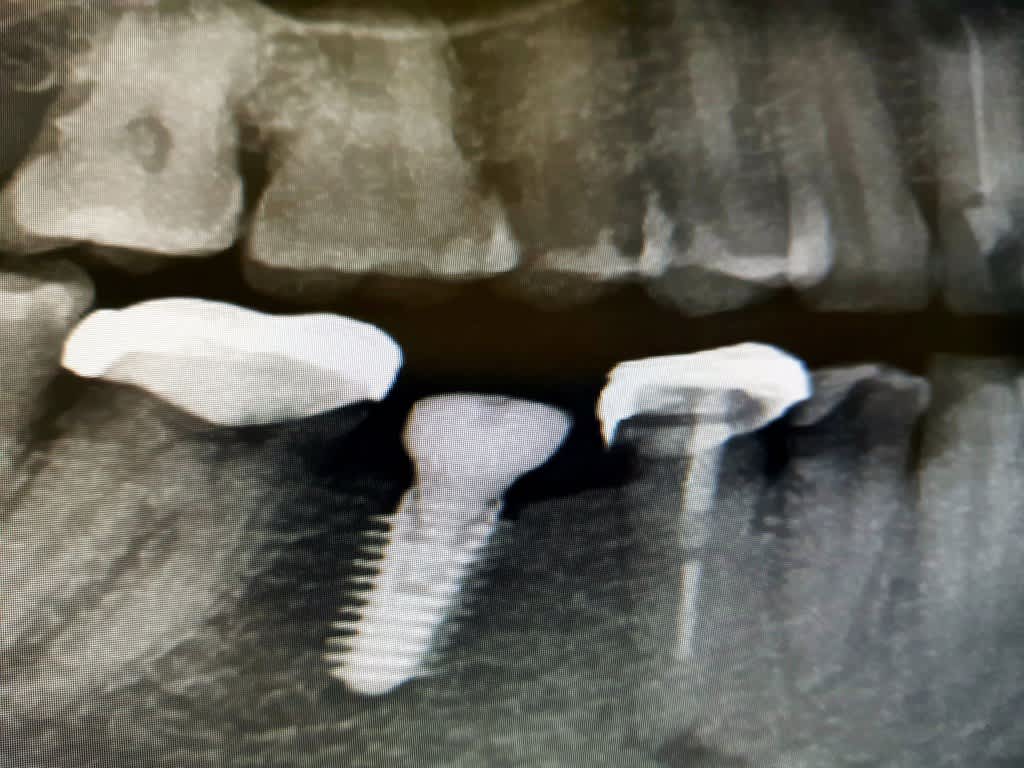 Shubhada Bhide dental implant singapore