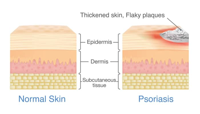 what is psoriasis singapore