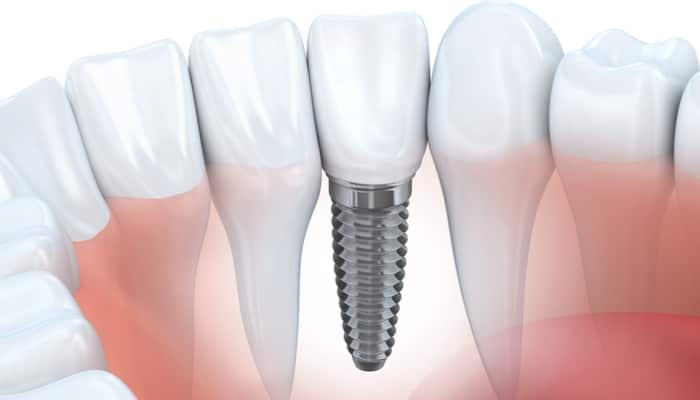 dental implant singapore