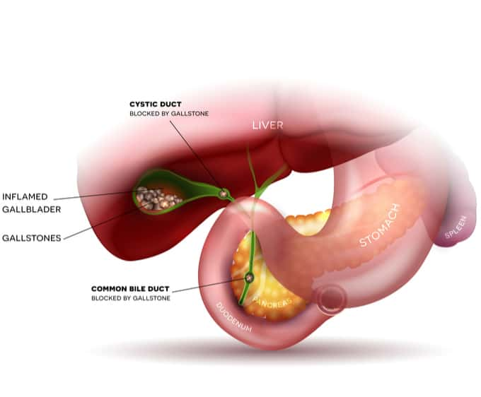 formation of gallstones