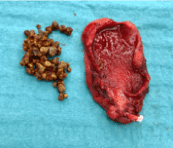 removed gallbladder and gallstones