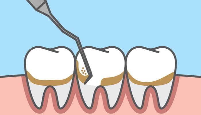 dental scaling