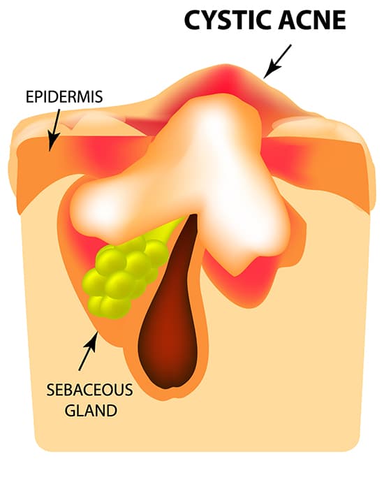 cystic acne singapore