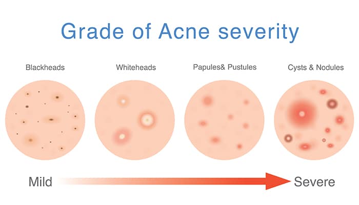 grade of acne severity singapore