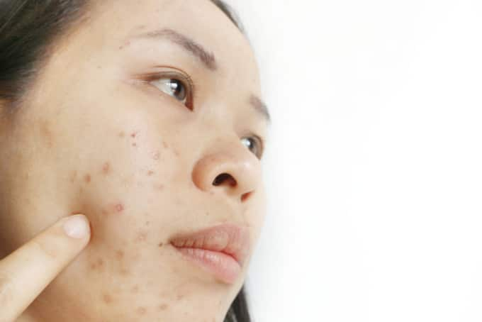 dark acne spots