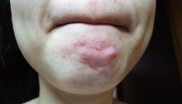 inflamed acne skin