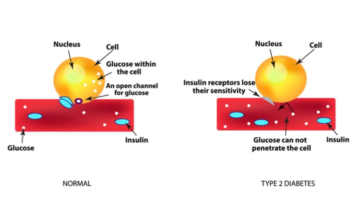 type 2 diabetes 