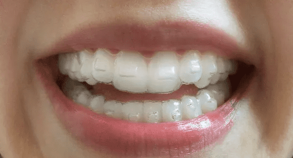 Invisalign clear aligners singapore