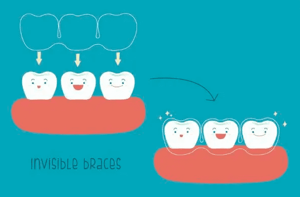 invisalign invisible braces singapore