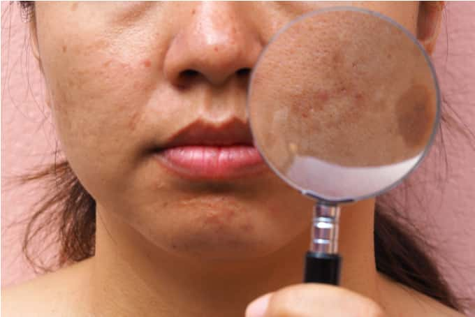 hyper pigmentation more common in asian