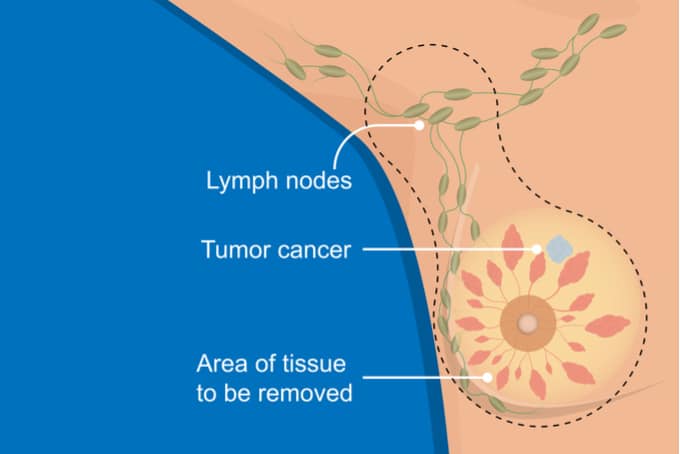 Lymphoedema and breast cancer
