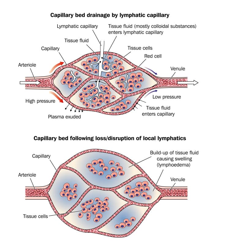 causes of lymphoedema singapore