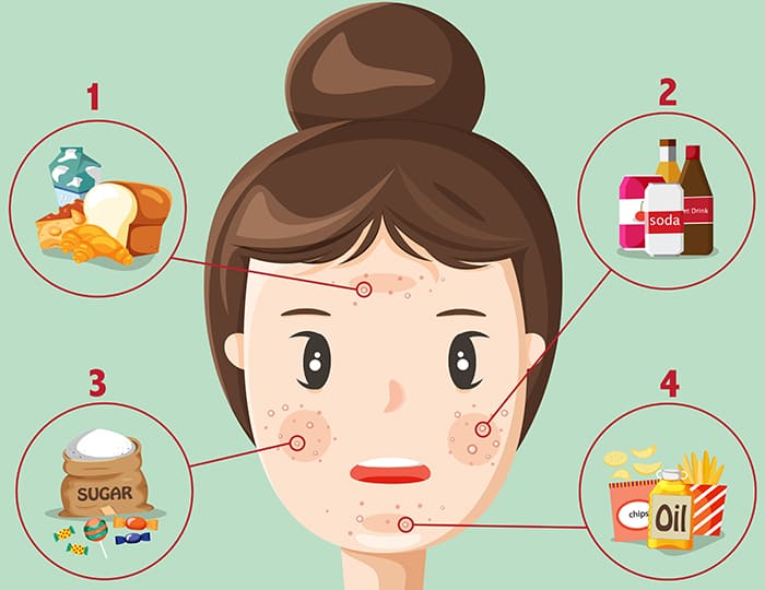 acne causing foods