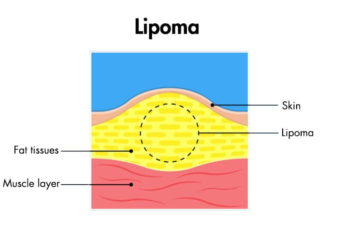 lipoma singapore