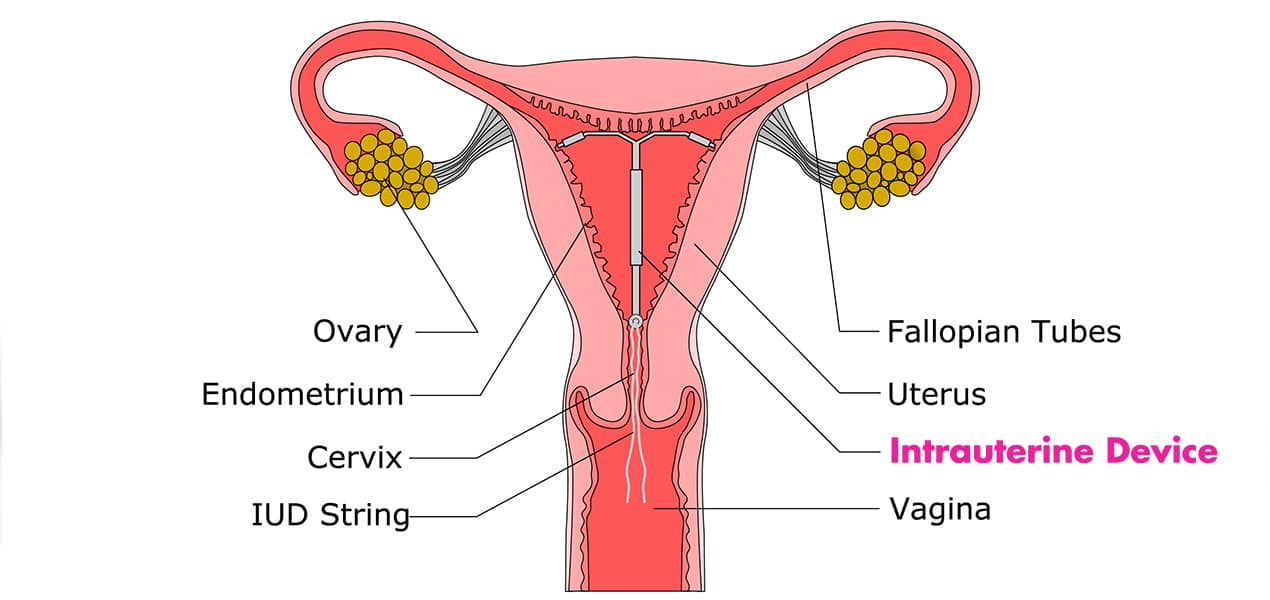 Intrauterine device singapore